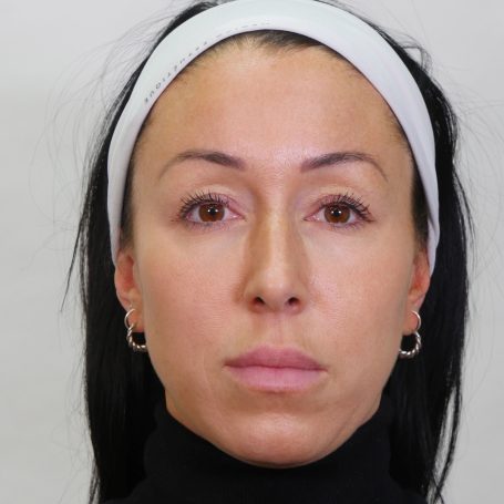 gobal-facelift-approach-after