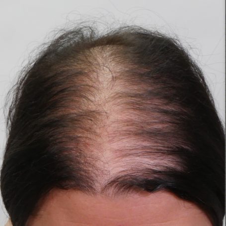 treatment-for-baldness-after