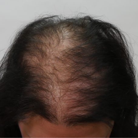 treatment-for-baldness-before